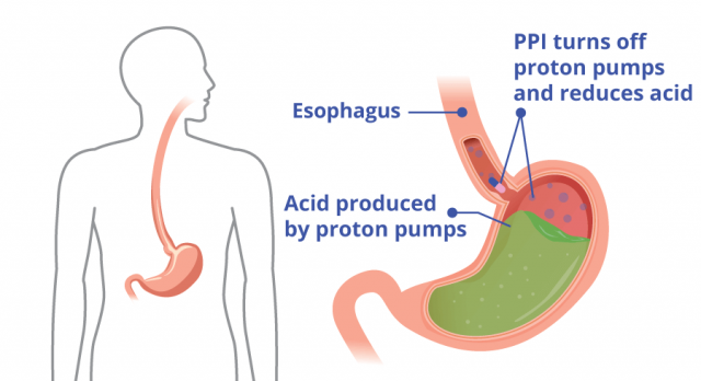 Diagram showing how PPIs reduce acid