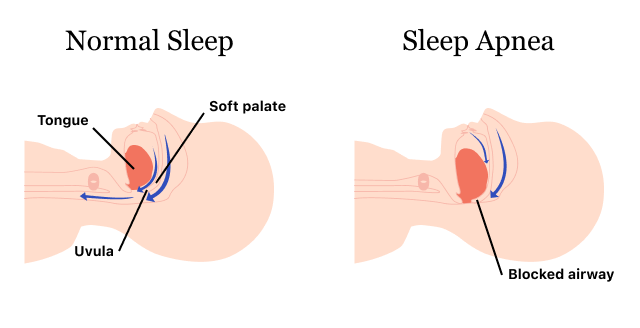 Graphic showing the mouth in normal sleep versus sleep apnea