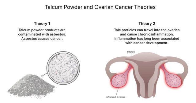 Infographic of talcum powder and ovarian cancer theories