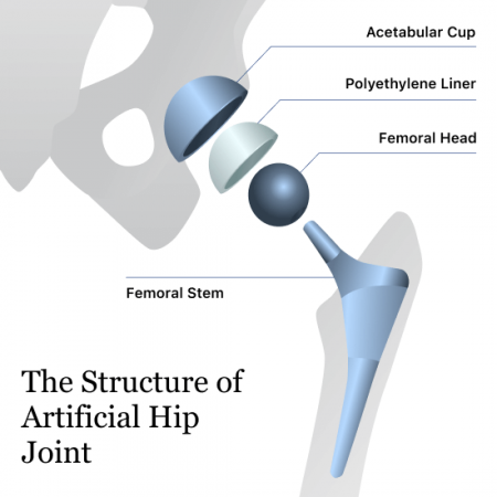 Diagram of a hip replacement