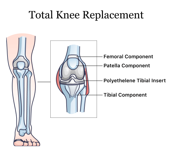 Diagram of a knee replacement