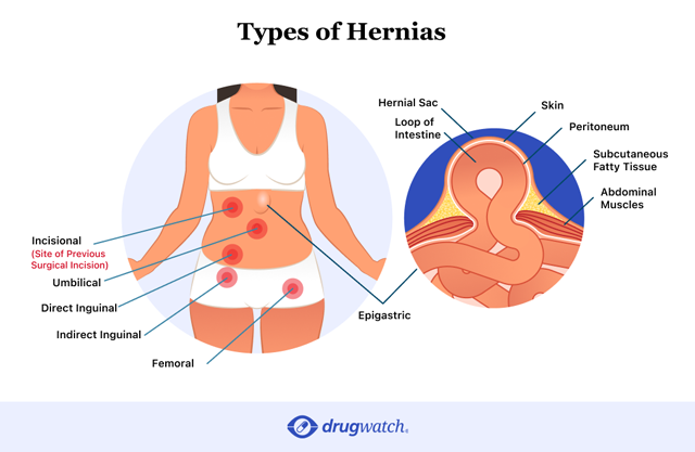 Diagram showing different types of hernias on the body.