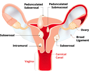 Diagram of Uterine Fibroid Types