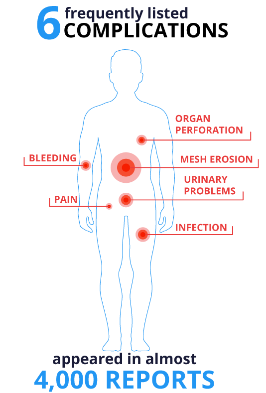 Frequent Mesh Complications Diagram